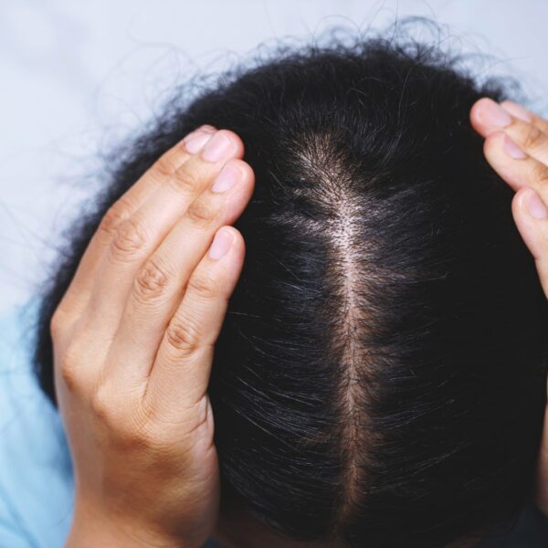 a woman with thinning hair